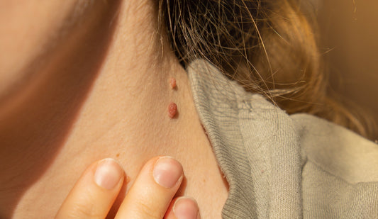 Acrochordon ou grain de beauté : comment faire la différence ?