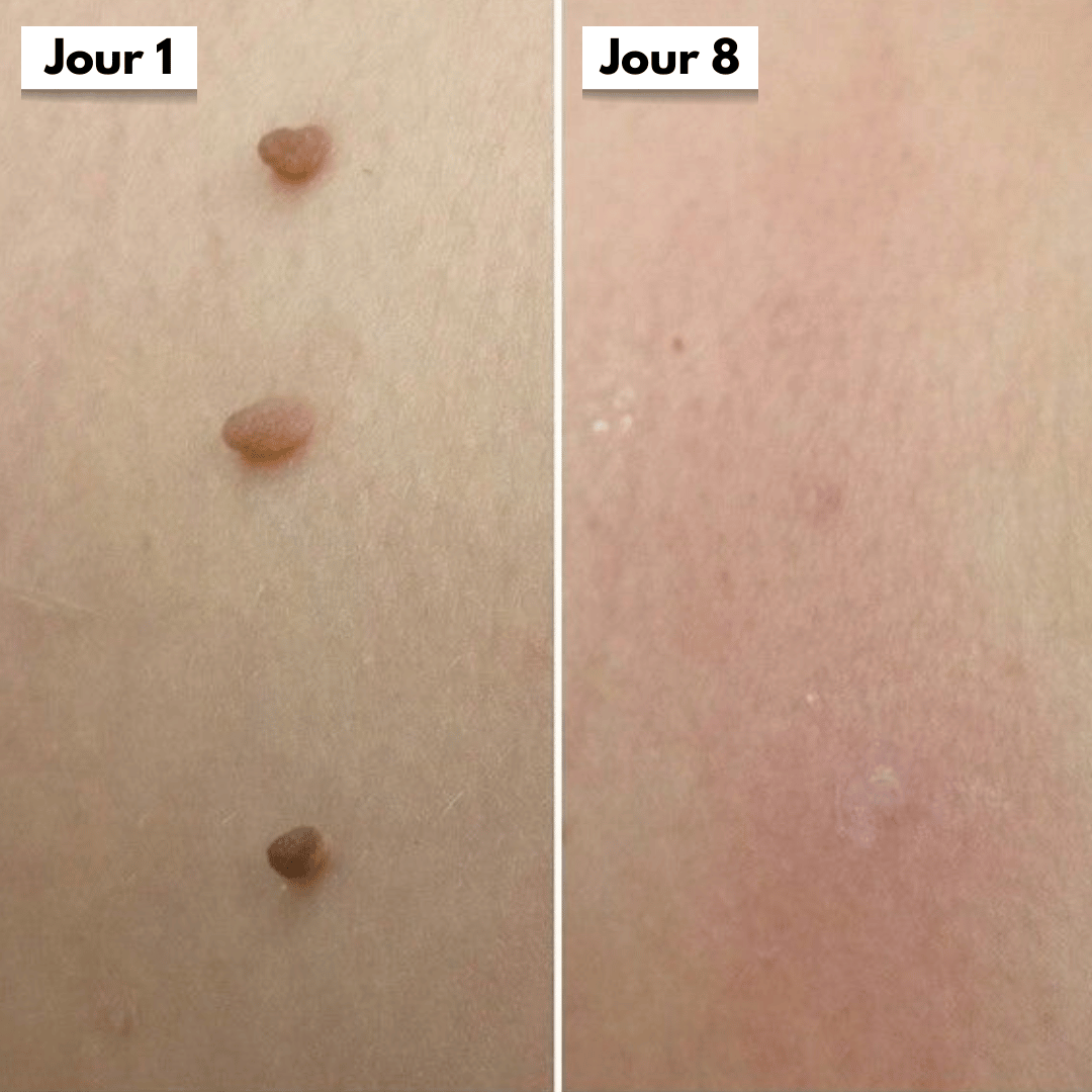 DermaSkin Pro™ - Adieu les acrochordons