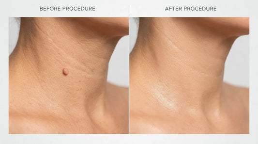 Comparaison avant après suppression grain beauté cou