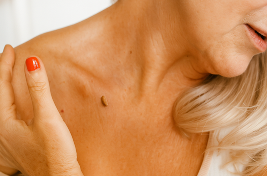 Acrochordon et âge : pourquoi apparaissent-ils plus souvent après 40 ans ?