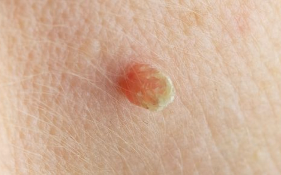 Peut-on enlever un acrochordon soi-même ? Ce qu’il faut savoir avant de se lancer