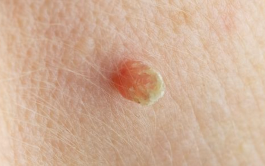 Peut-on enlever un acrochordon soi-même ? Ce qu’il faut savoir avant de se lancer