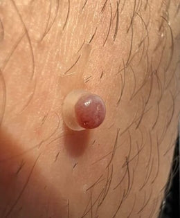 Acrochordons dermaskin pro