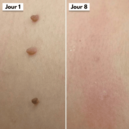 DermaSkin Pro™ - Adieu les acrochordons