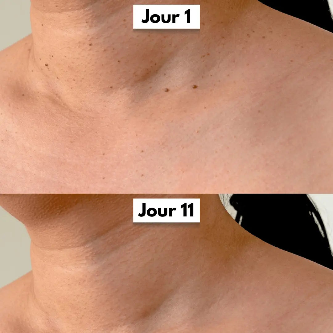 Résultat avant et après l’utilisation du Dermaskin Pro montrant la réduction visible d’un acrochordon.