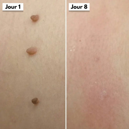 Photo comparative avant après démontrant l’action du Dermaskin Pro sur un acrochordon localisé.