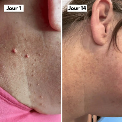 Comparaison avant après d’un acrochordon traité avec le Dermaskin Pro, amélioration en quelques jours.