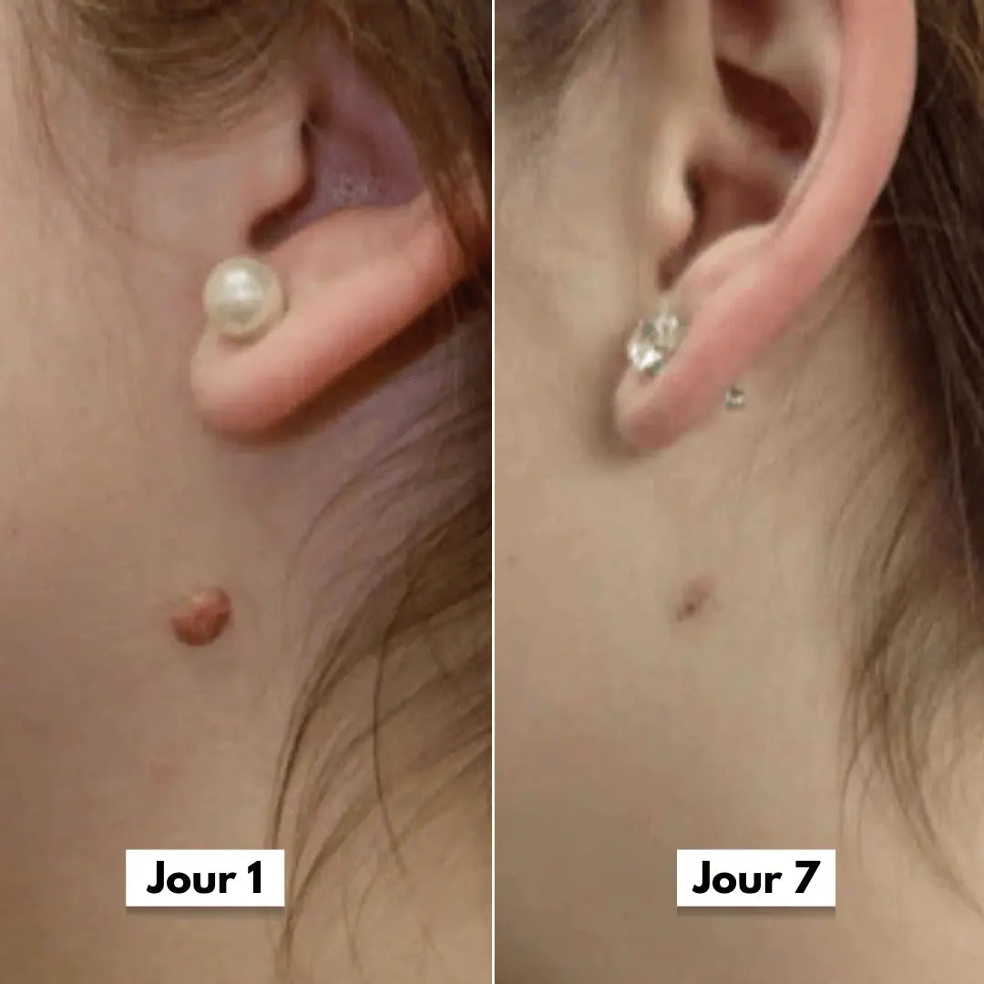 Photo avant après d’un traitement anti-acrochordons réalisé avec le Dermaskin Pro, peau plus nette et uniforme.
