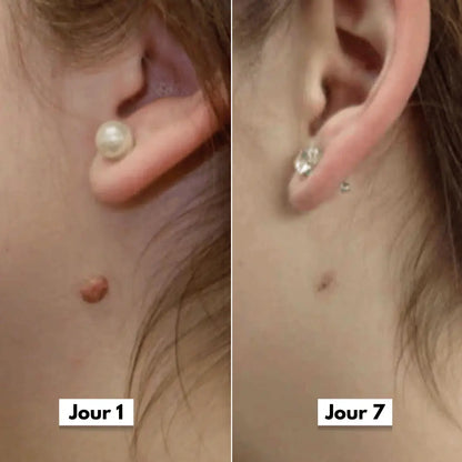Photo avant après d’un traitement anti-acrochordons réalisé avec le Dermaskin Pro, peau plus nette et uniforme.