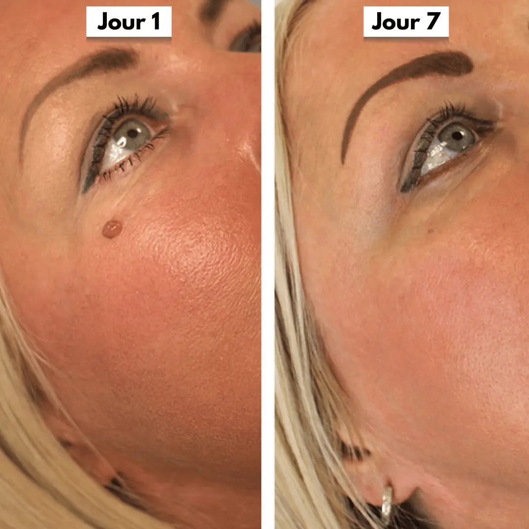 Résultat avant et après utilisation du Dermaskin Pro montrant la disparition progressive d’un acrochordon.